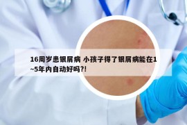 16周歲患銀屑病 小孩子得了銀屑病能在1~5年內(nèi)自動好嗎?!