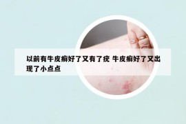 以前有牛皮癬好了又有了疣 牛皮癬好了又出現(xiàn)了小點點