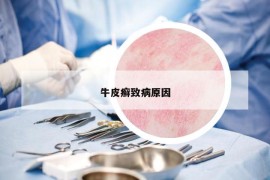牛皮癬致病原因