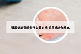 銀屑病能引起些什么其它病 銀屑病會(huì)加重么