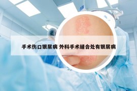 手術(shù)傷口銀屑病 外科手術(shù)縫合處有銀屑病