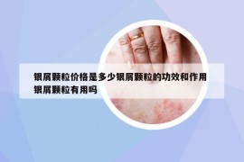 銀屑顆粒價格是多少銀屑顆粒的功效和作用 銀屑顆粒有用嗎