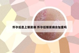 懷孕后患上銀屑病 懷孕后銀屑病會(huì)加重嗎