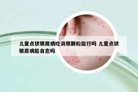 兒童點狀銀屑病吃消銀顆粒能行嗎 兒童點狀銀屑病能自愈嗎