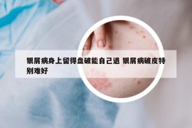 銀屑病身上留得盤破能自己退 銀屑病破皮特別難好