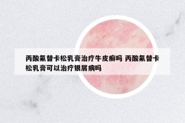 丙酸氟替卡松乳膏治療牛皮癬嗎 丙酸氟替卡松乳膏可以治療銀屑病嗎