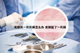 皮膚長(zhǎng)一片片癬怎么辦 皮膚起了一片蘚