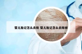 嬰兒胎記怎么去除 嬰兒胎記怎么去除掉