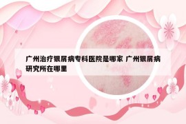廣州治療銀屑病?？漆t(yī)院是哪家 廣州銀屑病研究所在哪里