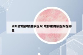 四川省成都銀屑病醫(yī)院 成都銀屑病醫(yī)院在哪里