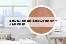 家里沒有人的銀屑病 家里沒人得銀屑病為什么會(huì)得銀屑病?