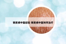 銀屑病中醫(yī)經(jīng)驗(yàn) 銀屑病中醫(yī)如何治療