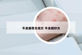 牛皮癬奇方絕方 牛皮癬妙方