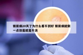 銀屑病20天了為什么看不到好 銀屑病就剩一點但是就是不消