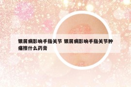 銀屑病影響手指關(guān)節(jié) 銀屑病影響手指關(guān)節(jié)腫痛擦什么藥膏