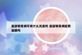 面部銀屑病可用什么洗面奶 面部銀屑病能敷面膜嗎