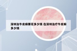 深圳治牛皮癬要花多少錢 在深圳治療牛皮癬多少錢