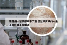 銀屑病一輩子都喝不了酒 患過銀屑病的人是不是終身不能喝酒