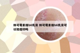 林可霉素維b6乳膏 林可霉素維b6乳膏可以祛痘印嗎