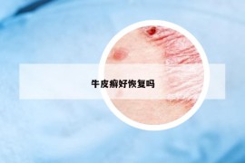 牛皮癬好恢復(fù)嗎