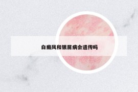 白癜風和銀屑病會遺傳嗎