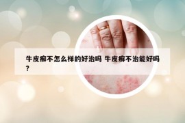牛皮癬不怎么樣的好治嗎 牛皮癬不治能好嗎?