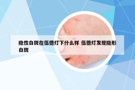 隱性白斑在伍德燈下什么樣 伍德燈發(fā)現(xiàn)隱形白斑
