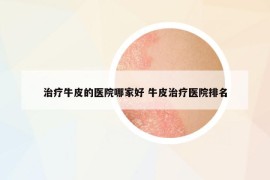 治療牛皮的醫(yī)院哪家好 牛皮治療醫(yī)院排名