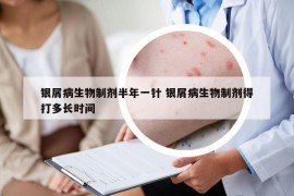 銀屑病生物制劑半年一針 銀屑病生物制劑得打多長時間