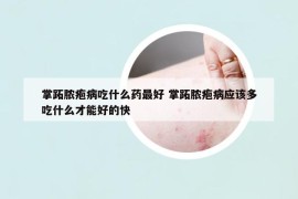 掌跖膿皰病吃什么藥最好 掌跖膿皰病應該多吃什么才能好的快