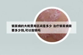 銀屑病的大概費(fèi)用區(qū)間是多少 治療銀屑病需要多少錢,可以報(bào)銷嗎