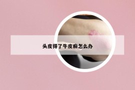 頭皮得了牛皮癬怎么辦
