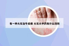 有一種火石治牛皮癬 火石火中藥有什么功效