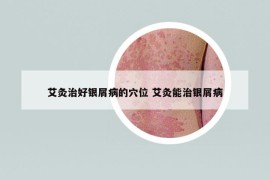 艾灸治好銀屑病的穴位 艾灸能治銀屑病