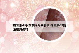 維生素d3衍生物治療銀屑病 維生素d3能治銀屑病嗎