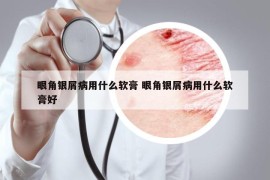 眼角銀屑病用什么軟膏 眼角銀屑病用什么軟膏好
