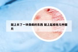 腿上長了一塊像癬的東西 腿上起癬有幾種圖片