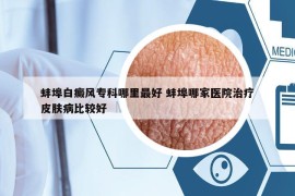 蚌埠白癜風(fēng)專科哪里最好 蚌埠哪家醫(yī)院治療皮膚病比較好