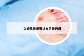 白癜風(fēng)患者可以自己用藥嗎