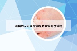 有癬的人可以泡澡嗎 皮膚癬能洗澡嗎
