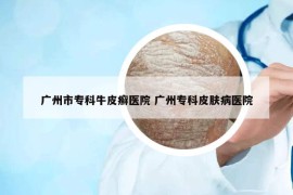 廣州市專科牛皮癬醫(yī)院 廣州?？破つw病醫(yī)院