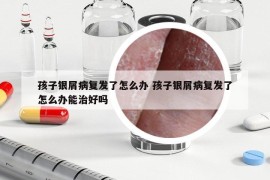 孩子銀屑病復發(fā)了怎么辦 孩子銀屑病復發(fā)了怎么辦能治好嗎
