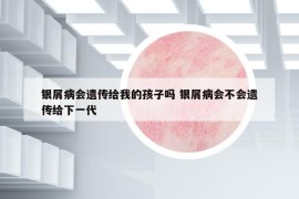 銀屑病會遺傳給我的孩子嗎 銀屑病會不會遺傳給下一代