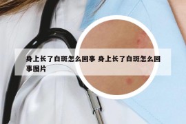 身上長了白斑怎么回事 身上長了白斑怎么回事圖片