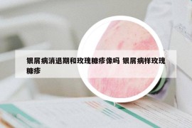 銀屑病消退期和玫瑰糠疹像嗎 銀屑病樣玫瑰糠疹