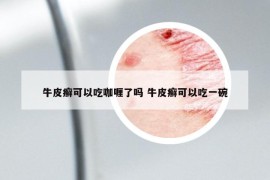 牛皮癬可以吃咖喱了嗎 牛皮癬可以吃一碗