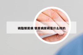 磷脂銀屑病 銀屑病屑磷是什么樣的