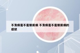 不發(fā)癢是不是銀屑病 不發(fā)癢是不是銀屑病的癥狀