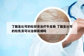 丁酸氫化可的松軟膏治療牛皮癬 丁酸氫化可的松乳膏可以治銀屑病嗎