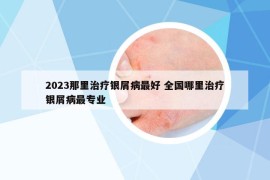 2023那里治療銀屑病最好 全國(guó)哪里治療銀屑病最專(zhuān)業(yè)